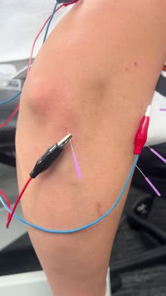 Dry needling treatment