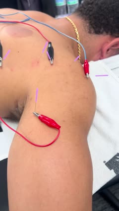 Dry needling with electrical stimulation